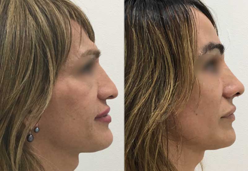 Facial Feminization Surgery before and after - FFS Pictures