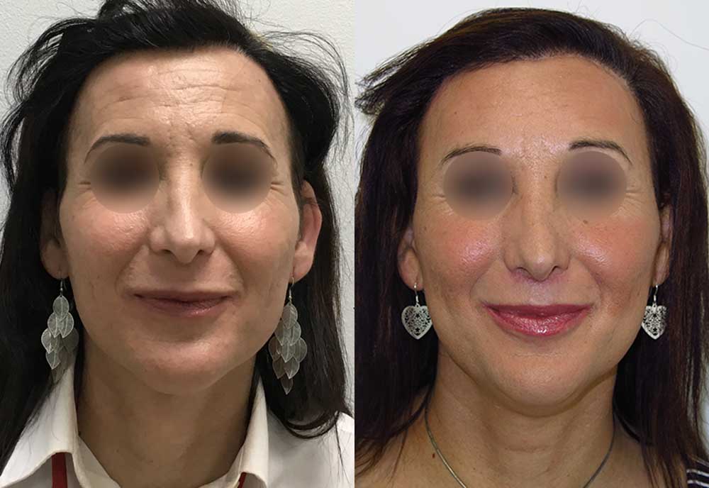 Facial Feminization Surgery: Before and After Gallery, Otolaryngology