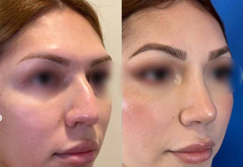 Feminización facial de nariz y frente perfil