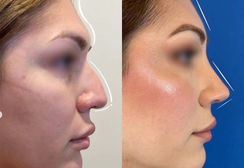 Feminización facial de nariz y frente después de 8 meses