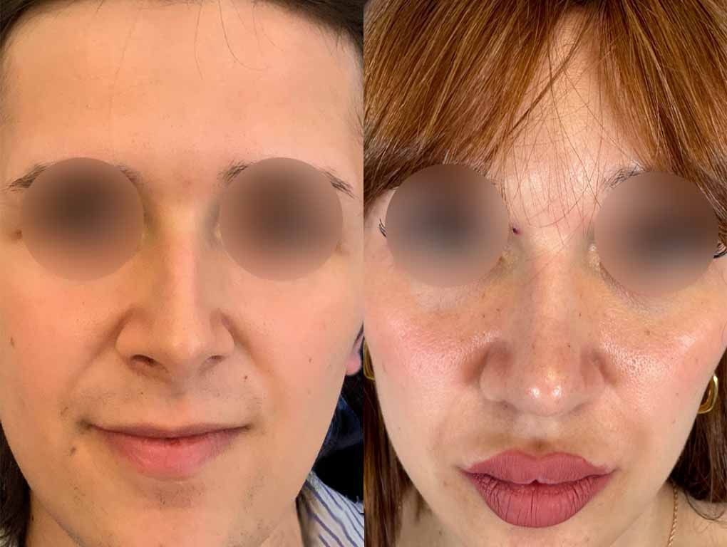 Facial feminization: front and rinoplasty